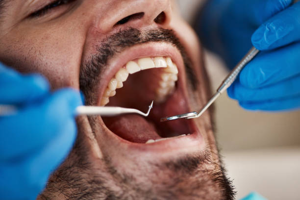 Best Emergency Wisdom Teeth Removal in Vaughn, WA