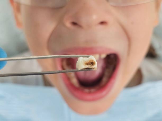 Best Emergency Tooth Extraction in Vaughn, WA